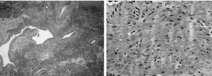 Fig. 4. (A) Histologic section showed circumferentially arranged muscle cells and inclusion of slit-like vascular channels (H&amp;E stain,
