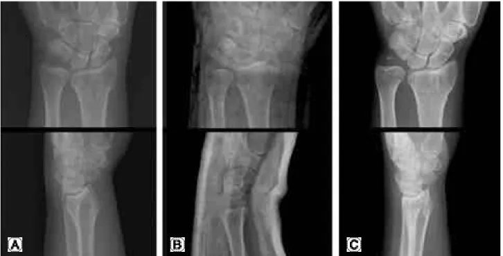 Fig. 1. (A) Initial radiograph of a 63-years old woman (B) The fracture was treated with manual reduction and cast immobilization (C) At 16 months later, radiographically poor results were observed, but she has no pain and good wrist function
