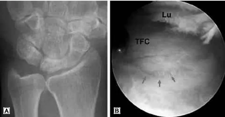Fig. 2. 58 years-old male patient who had stage 3 Kienböck’s disease and concomitant ulnocarpal impingement