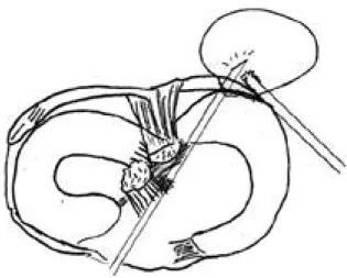 Fig. 6. Final arthroscopic view which shows completion of cys- cys-tic removal. All procedure was done within cyst.