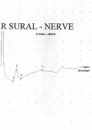Figure 1. Initial  NCV  shows  normal  compound  nerve  action  potentials  (CNAP's)  in  Rt