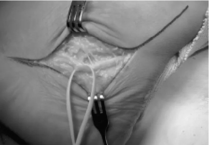 Figure 4. In  1  Month  after  decompression  of  sural  nerve,  NCV  shows  almost  normal  CNAP's  in  Lt