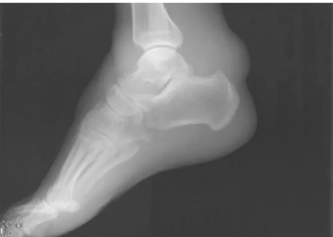 Figure 2. MRI  images  of  left  ankle.  (A)  T1  weighted  sagittal  image  shows  large  sized  mass  of  low  signal  intensity  in  anterior  aspect  of  ankle  and  cortical  erosion  at  posterior  aspect  of  calcaneus