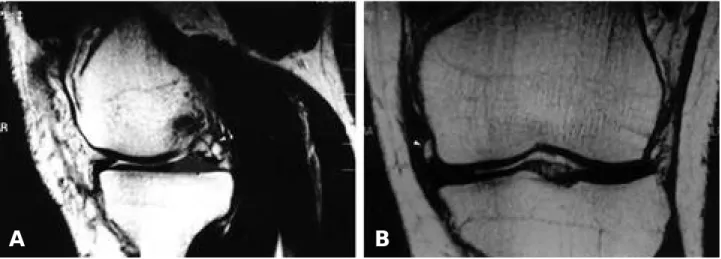 Fig. 2. Arthroscopic finding through anterolateral portal shows bulged meniscal cyst located in mid medial  meniscocap-sular junction
