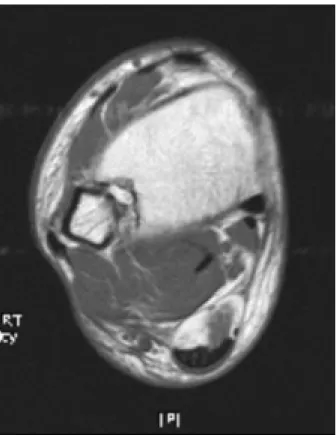 Figure 1. MRI  finding  of  acute  peroneal  tendon  dislocation. 단과 치료로 만성 탈구로 이환 하지 않도록 하여야 한다