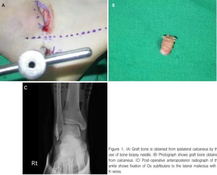 Figure 1. (A)  Graft  bone  is  obtained  from  ipsilateral  calcaneus  by  the  use  of  bone  biopsy  needle