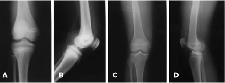 Fig. 1. X-ray films?show the type III tibial spine fractures in case No. 1. 