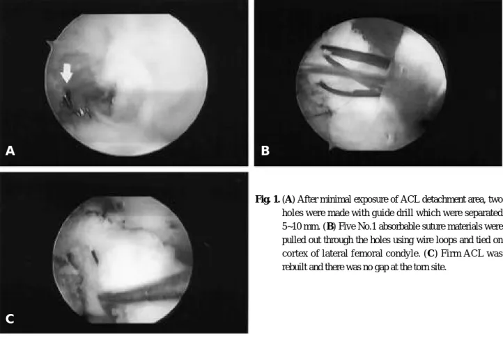 Fig. 1. (A) After minimal exposure of ACL detachment area, two holes were made with guide drill which were separated 5~10 mm