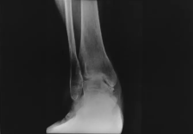 Figure 2. Anteroposterior  radiograph  showing  stage  2B  osteoarthritis  with  loss  of  joint  space  between  med