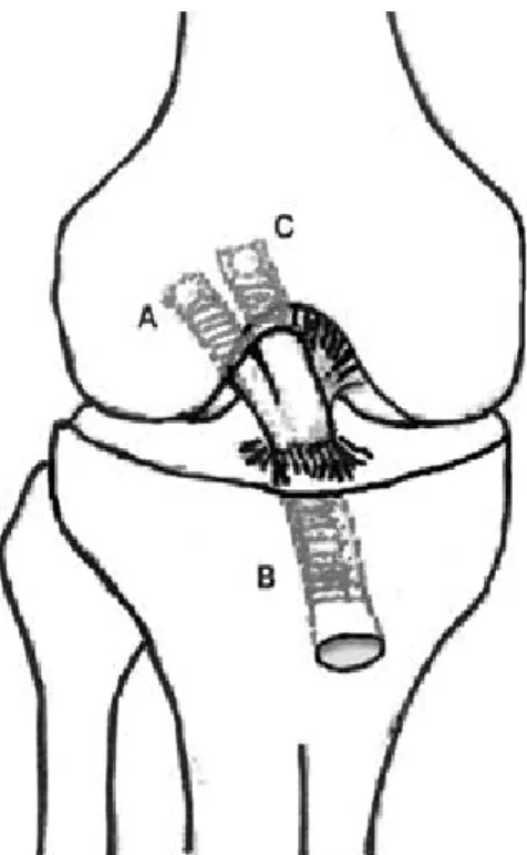 Fig. 4. (A) First, femoral fixation of the posterolateral bundle graft is obtained with the absorbable interference screw through the accessory anteromedial portal with the knee in 90 degree of flexion