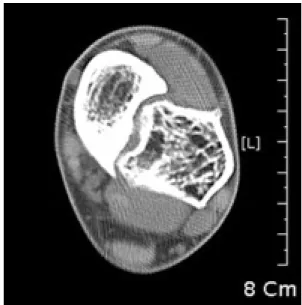 Figure 2. Axial  CT  shows  no  bony  connection  between  the  tibia  and  fibular  bony  mass.
