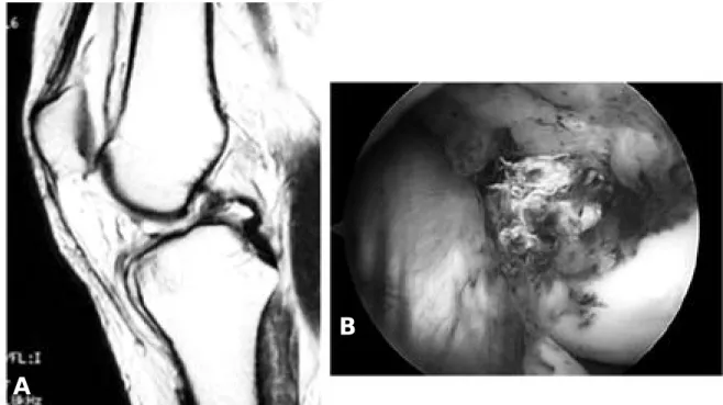 Fig. 1. Acute PCL tear at femoral attachment (A) sagittal T1-weighted image shows PCL tear at femoral attachment with retracted posterior compartment