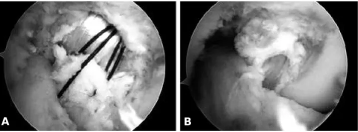 Fig. 5. (A) Arthroscopic viewing from the anterolateral portal of the right knee shows the passage of graft with repaired torn PCL stump to femoral tunnel