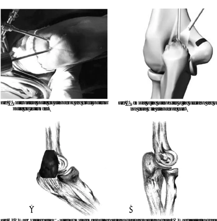 Fig. 2. Removal of the osteophytes of the olecranon and olecra- olecra-non fossa with arthroscopic burr.