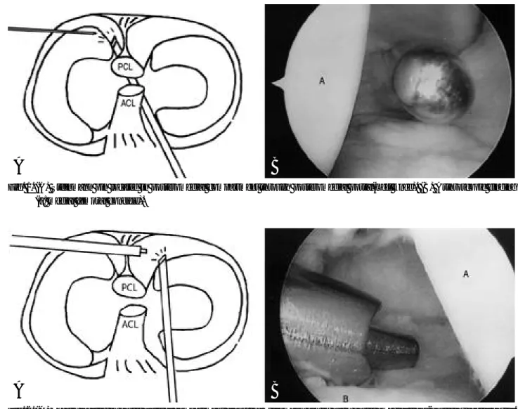 Fig. 2. (A) Sheath located in posterolateral compartment along the Steinmann pin through posteromedial trans-posterior septal portal.