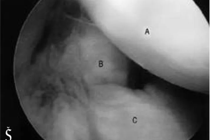 Fig. 3. (A) Posterolateral compartment is visualized through posteromedial trans-posterior septal portal