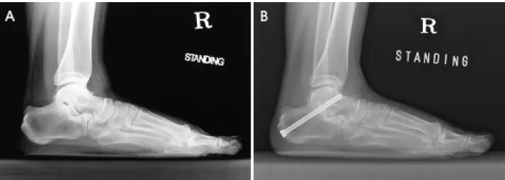 Figure 1. A  42-year-old  female  developed  right  subtalar  joint  pain  after  motor  vehicle  accident