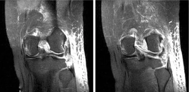 Fig. 1. Coronal section of MRI was shown nearly complete rupture of lateral collateral ligament at fibular attatchment site and rup- rup-ture of lateral joint capsule.