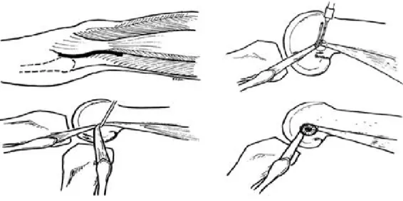 Fig. 4. Reconstruction by biceps tendon rerouting for posterolateral rotatoty instability of the knee : Modification of the Clancy tech- tech-nique.