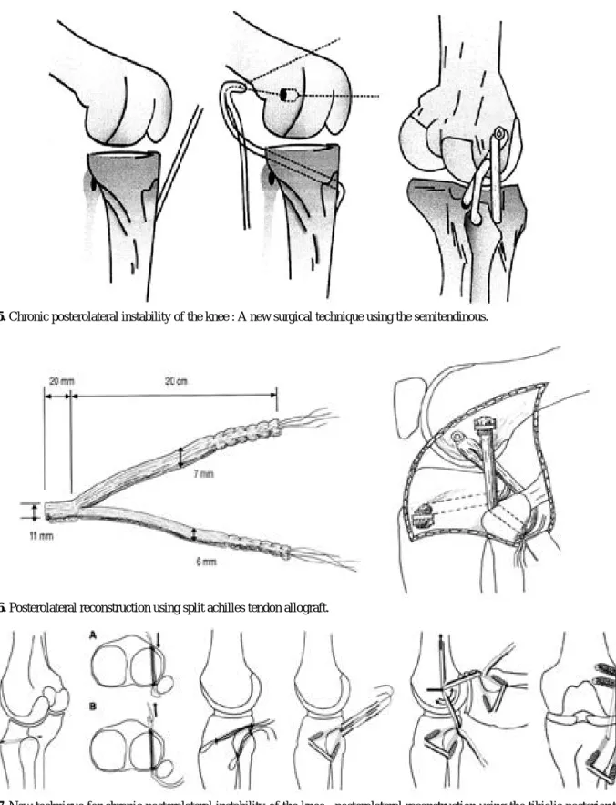 Fig. 5. Chronic posterolateral instability of the knee : A new surgical technique using the semitendinous.