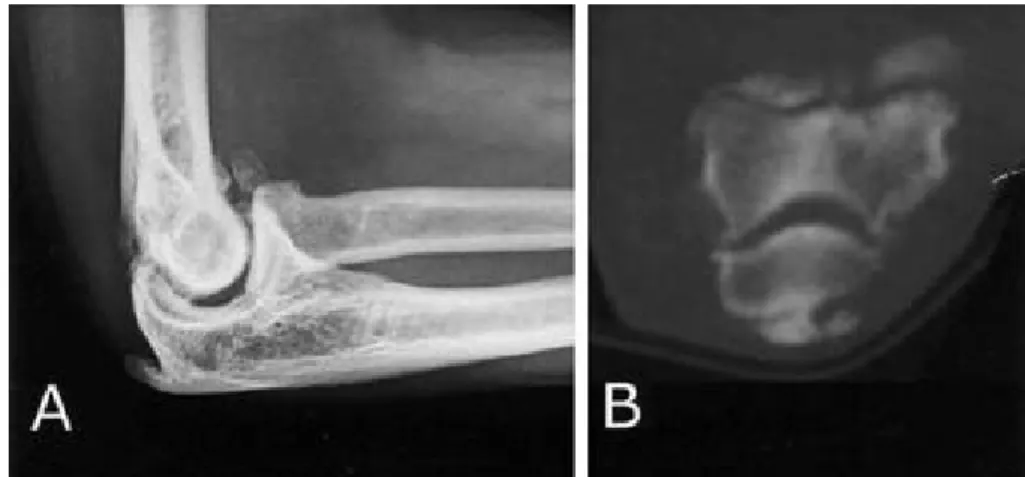 Fig. 2. Preoperative lateral radiograph (A) and CT scan (B) shows extensive osteophytes located in the olecranon, coronoid process, and olecranon fossa, which indicates advanced arthritis of radiohumeral and ulnohumeral joint