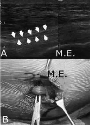 Fig. 3. Postoperative radiographs show fenestration of olecranon fossa with improved flexion of 120° .