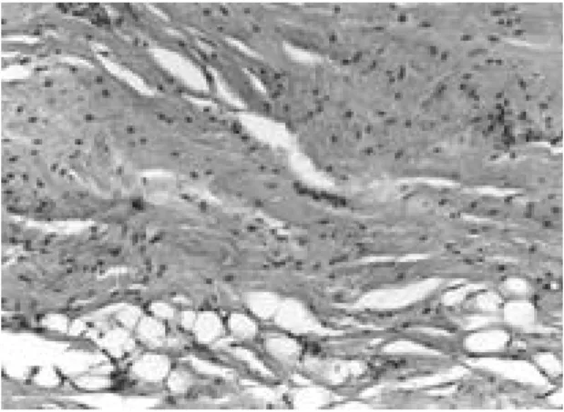 Fig. 3. Histologic features of elastofibroma shows colla- colla-gen fibers interlaced with elastic fibers