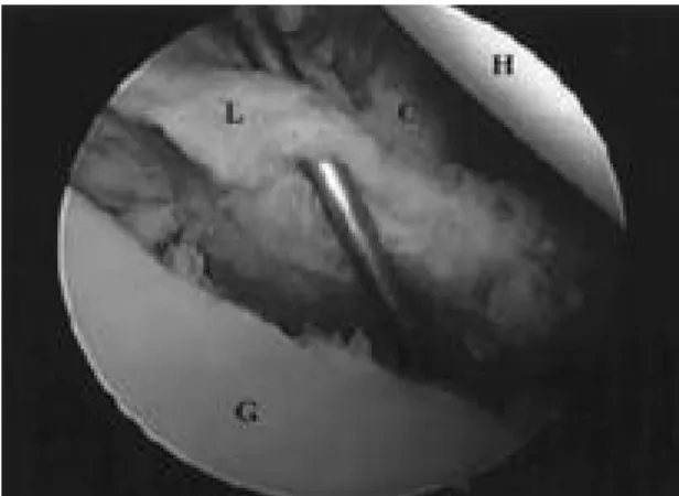 Fig. 2. (A) Detached labrum in the recurrent dislocation looks inelastic, fibrillated and displaced