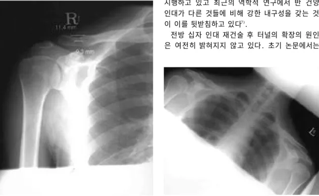 Fig. 3. Right shoulder anteroposterior x-ray at final fol- fol-low-up. Different view also showed tunnel widening from 9.3 to 11.4 mm.
