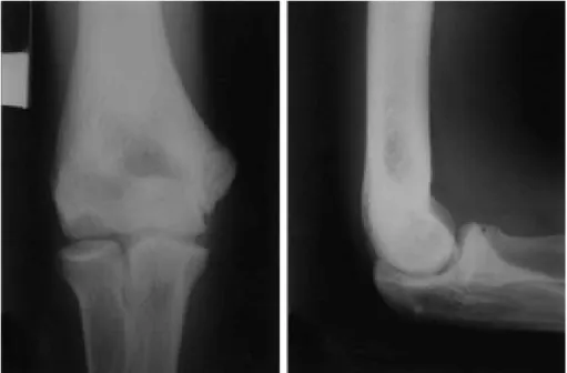 Fig. 1. Radiographs demonstrating radiolucency and rarefaction of osteochondritis dissecans of the elbow.