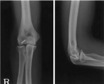 Fig. 3. Radiographs demonstrating fixation with headless screw of lesion site.