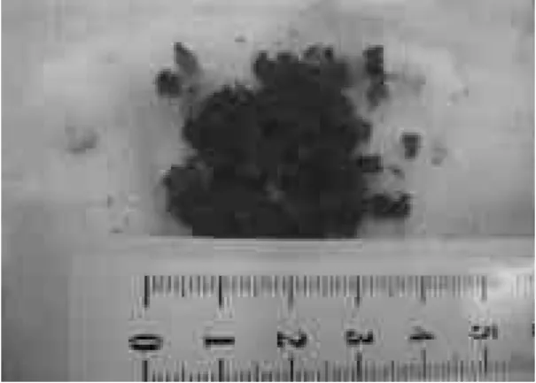 Fig. 6. Endoscopic images in surgical field. (A) The whitish soft tissue is seen on endoscopic image before complete curettage
