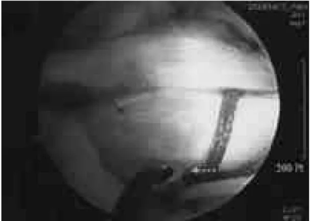 Fig. 6. The arthroscopic photographs showing anchor that will be inserted in cuff insertion site of greater tuberosity.