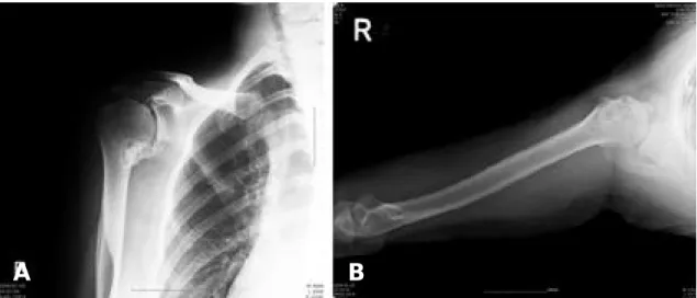 Fig. 1. Plain X-rays of the right shoulder showing the extent of the heterotopic ossification between the proximal humerus and at the vinicity of the coracoid process.