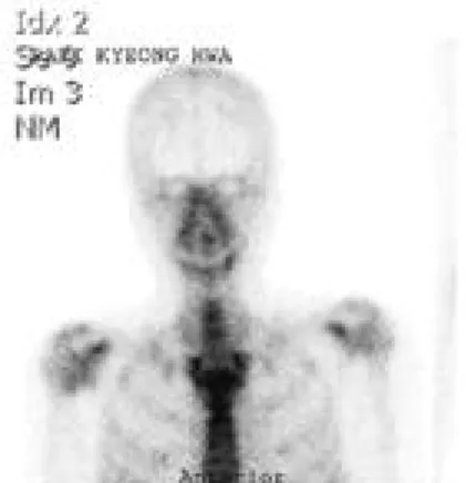 Fig. 4. There are only mature bone trabeculae without zonal phenomenon.