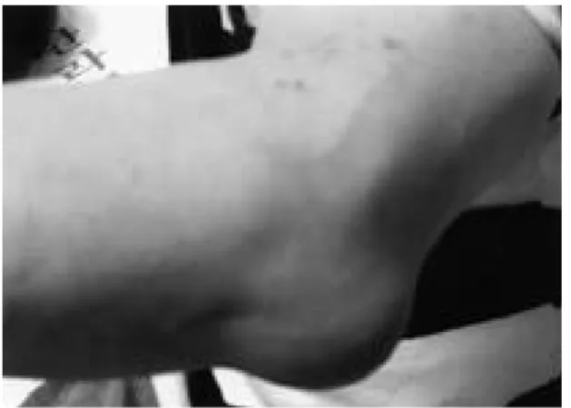Fig. 2. The photograph shows resolution of the bursitis after treatment. 