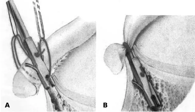 Fig. 2. (A) The Utility loop and balancing loop are used to balance the Anchor loop during anchor insertion (B) The Utility loop and inserter rod are removed after a secure , low profile repair is achieved