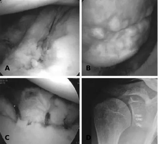 Fig. 4. (A) Arthroscopic view of Right shoulder in 20 years old male shows ALPSA lesion, Glenoid bone defect