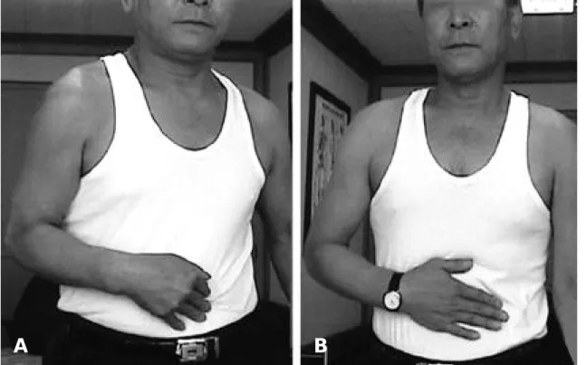 Fig. 1. Napoleon test. (A) Positive Napoleon sign indicates a nonfunctional subscapularis
