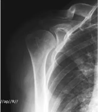 Fig. 1. Radiographs showed soft tissue mass in the region of the proximal humerus without soft tissue calcifications.