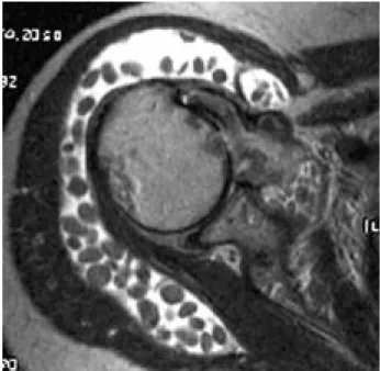 Fig. 5. MR imaging showed slightly hyperintense on T2- T2-weighted spin-echo images relative to the hypointense skeletal muscle.