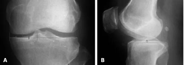 Fig. 1. The joint space change was evaulated on standing AP and lateral view. ( A) On AP view, the joint space is the distance at mid- mid-portion between medial side of medial tibial condyle and medial tibial spine