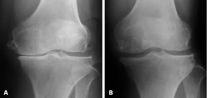 Fig. 3. (A) Preoperatively, the medial joint space on weight bearing AP view was 1.2 mm