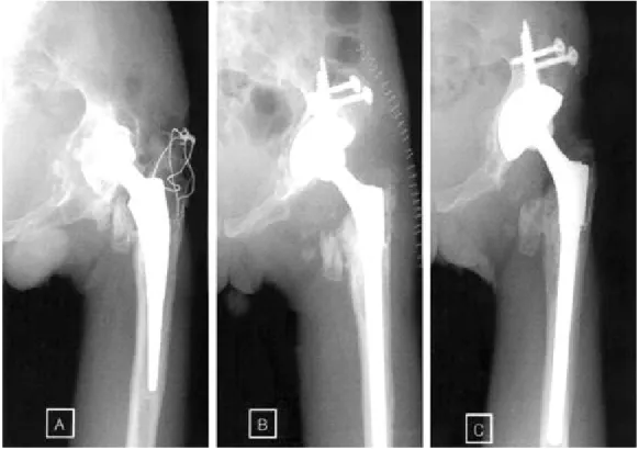 Fig. 2. A 45 year-old male who received THRA 8 years ago for traumatic AVN.