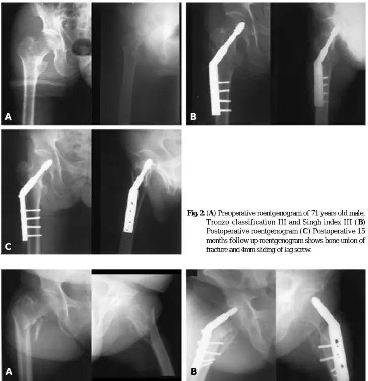 Fig. 2. (A) Preoperative roentgenogram of 71 years old male, Tronzo classification III and Singh index III ( B) Postoperative roentgenogram ( C) Postoperative 15 months follow up roentgenogram shows bone union of fracture and 4mm sliding of lag screw.