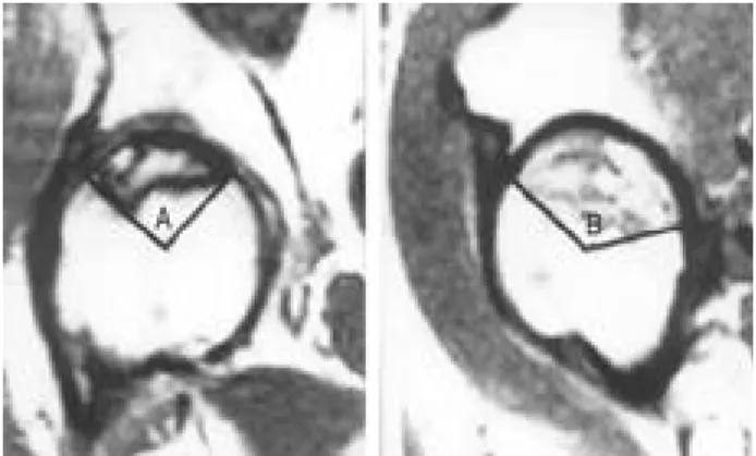 Fig. 1. The calculation of the combined necrotic angle from MRI scan. (A) The angle of necrotic area in  coronal image