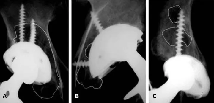 Fig. 1. (A) Diffuse osteolysis type, (B) Localized osteolysis type, (C) Peri-screw osteolysis type.