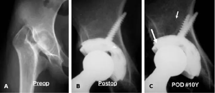Fig. 3. (A) The preoperative AP radiograph of a 22-year-old female with septic hip sequlae