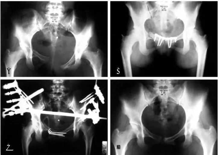 Fig. 1. Radiographs and photograph of a 26 year old woman. (A) Her pelvic injuries include a wide fracture and separation of the symphysis pubis