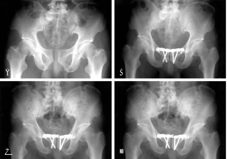 Fig. 2. Radiographs of a 51-year-old-man. ( A) His pelvic injuries include a wide symphyseal separation